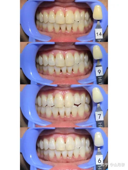 牙科医生眼中真正有效的美白及口腔卫生用品
